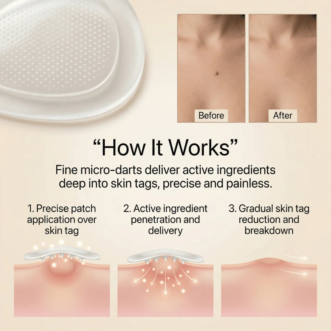 DermaSmooth - Skin Tag Remover Patch 🔥 BUY 1 GET 1 FREE 🔥